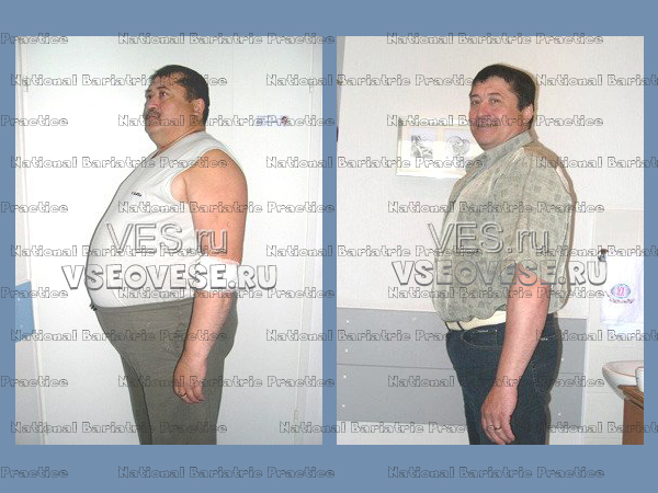 Вес после бариатрической операции. Шунтирование желудка до и после. Люди до и после резекции желудка. Шунтирование желудка для похудения. Операция шунтирования желудка для похудения.